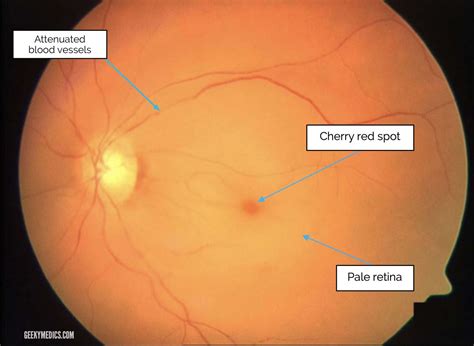 Discover How an Experienced Optometrist Can Help You Find Relief From Retinal Artery Occlusion